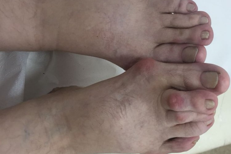 Psoriatik Artrit