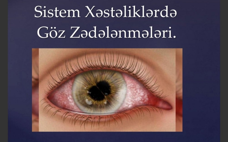 Sistem Xəstəliklərdə Göz Zədələnmələri